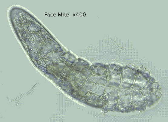 Phát hiện loài bọ ve siêu nhỏ trên mặt và đầu con người